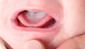 Buccal Thrush