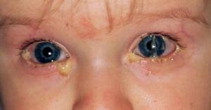 Common Conditions of the Eye in Childhood