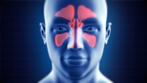 Sinusitis