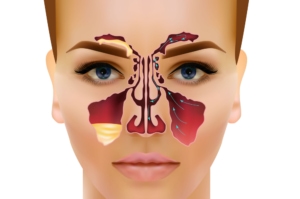 Sinusitis