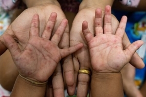 Homeopathic Remedies for Hand Foot and Mouth Disease