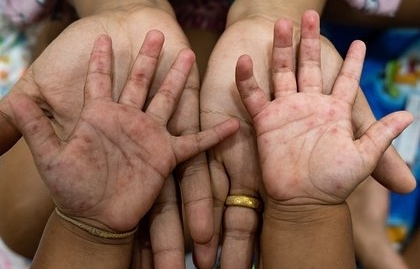 Homeopathic Remedies for Hand Foot and Mouth Disease